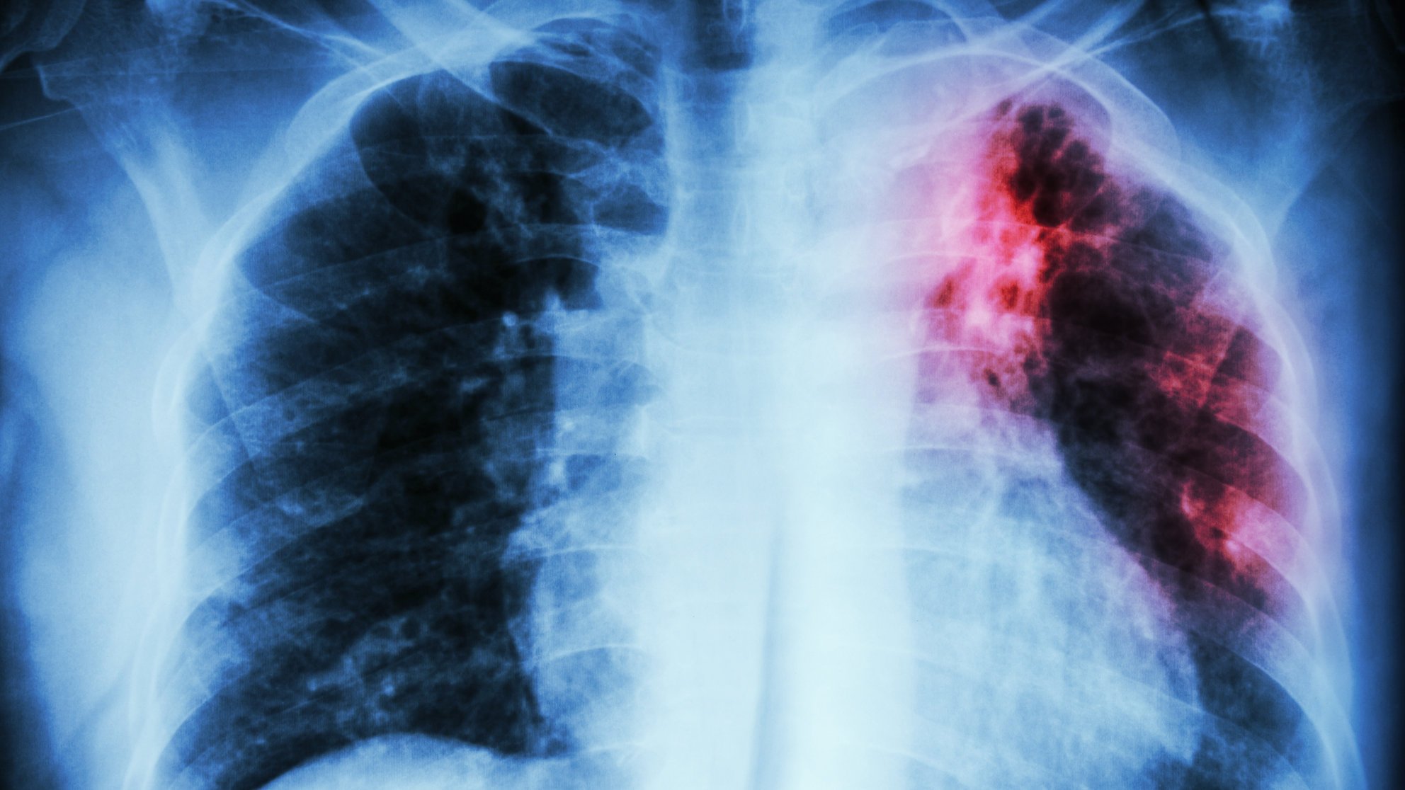 85 pct of Tuberculosis cases undetected in Ogun – Commissioner for Health