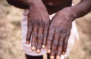 Monkey-pox-TVCNews