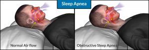 sleep-apnea
