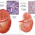 diseased_kidney-tcnews