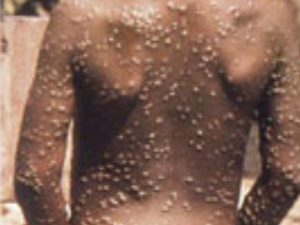 Kwara records first case of Monkeypox