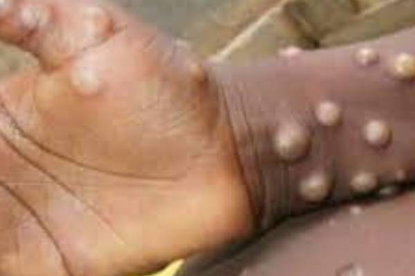Ogun Monkeypox