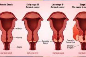 CERVICAL CANCER