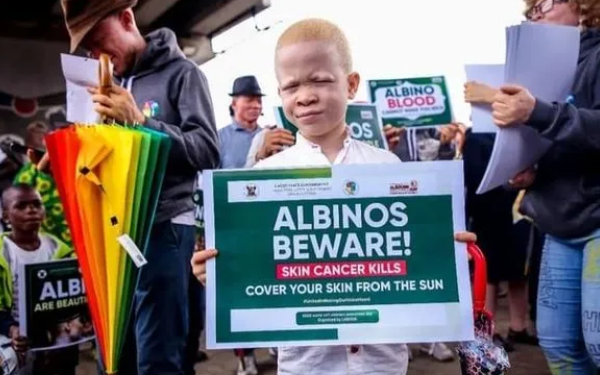 Cancer Prevention Measures for People Living with Albinism