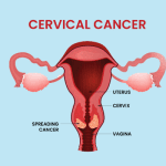Cervical cancer remains a significant public health concern, with millions of women worldwide affected by this preventable disease.