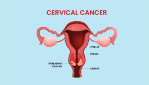 Cervical Cancer A Global Public Health Concern